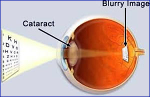 cataract-1