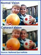 cataract-2