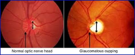 glaucoma-1